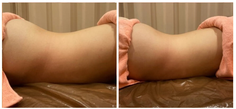 背面からも施術するので、腰回りもスッキリ